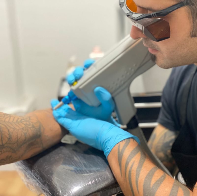 Eliminación de tatuajes con láser en Lleida